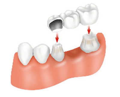 Dental Crowns