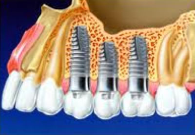 Dental implants