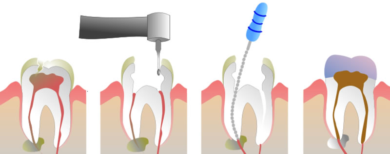 Root Canal Therapy