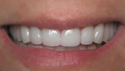 porcelain veneers