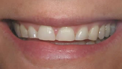 porcelain veneers