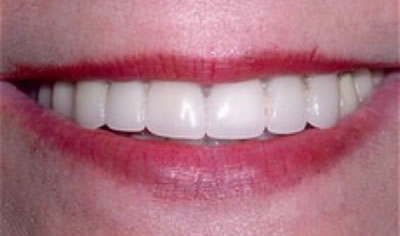 porcelain veneers