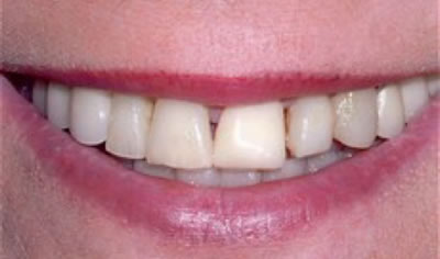 porcelain veneers