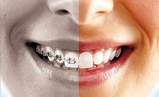 Invisalign | Havelock | Dr. Vipin Grover