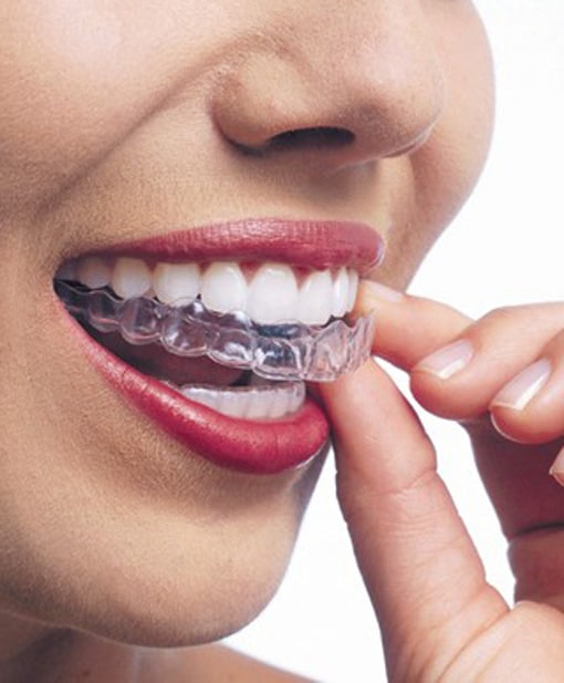 Invisalign | Havelock | Dr. Vipin Grover